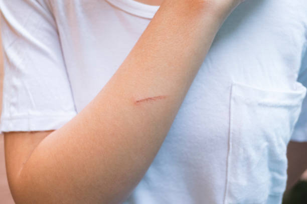 istock Close up of brown lesion from iron. Lesion burn from iron. 1056621120