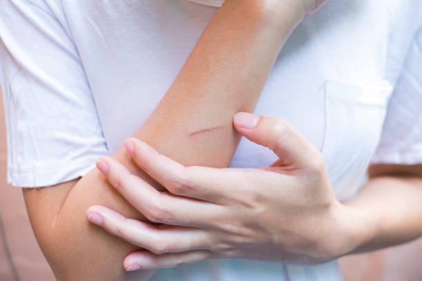 istock Close up of brown lesion from iron. Lesion burn from iron. 1056621136