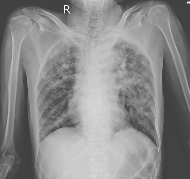 radiografía de tórax muestra infiltración pulmonar intersticial con cavidades secas ambas tuberculosis pulmonar los pulmones. - interstitial fotografías e imágenes de stock