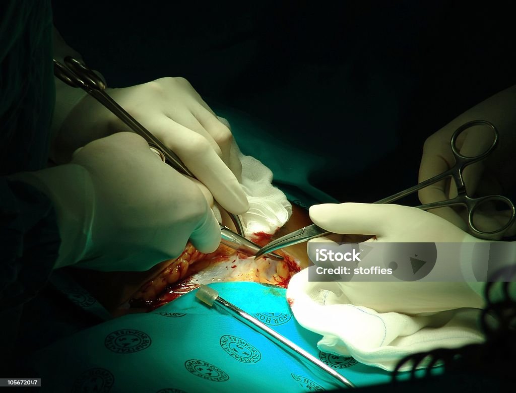 Under the knife  Caesarean Section Stock Photo