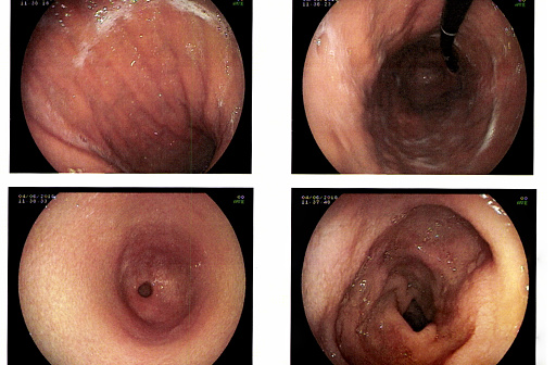 Report Esophagogastroduodenoscopy or EGD medical image.