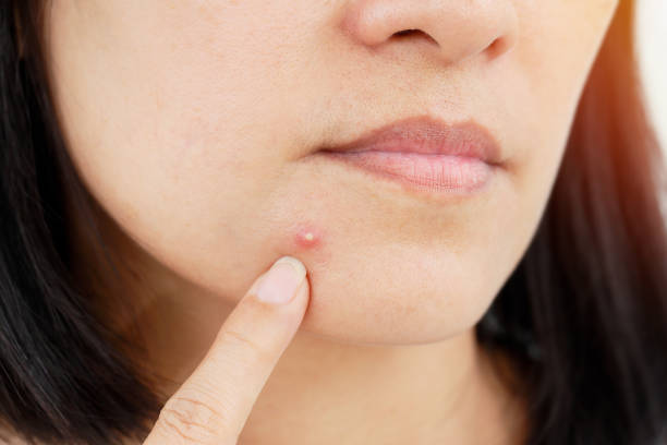 big acne check skin and acne closeup pimple photos stock pictures, royalty-free photos & images