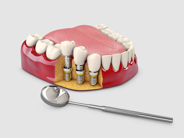 istock Human teeth and Dental implant. 3d illustration 1056917358