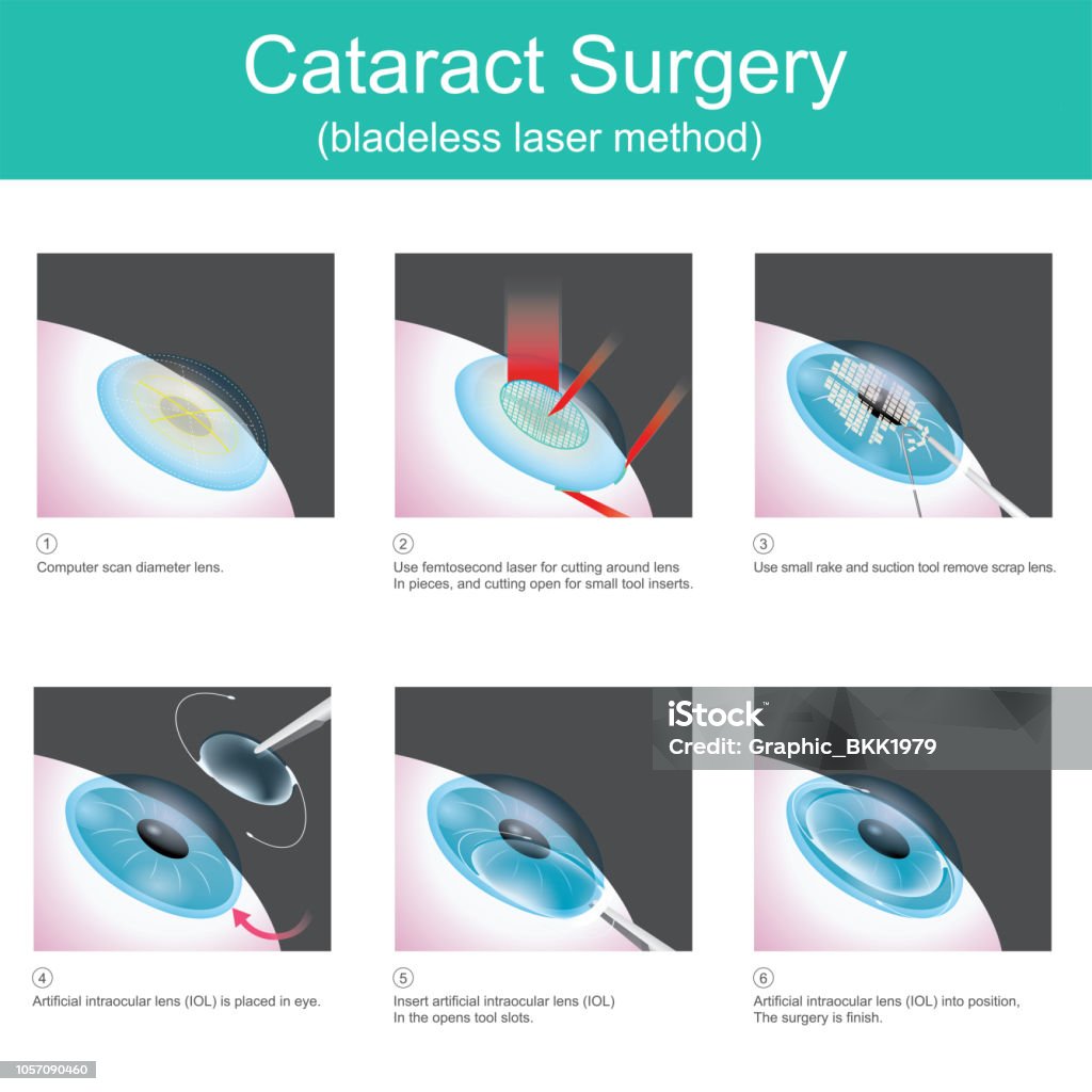 Cataract Surgery The use of medical lasers to cutting eye lens in small pieces and suction out, in order to use artificial lenses, because the symptoms are cataracts. Cataract stock vector