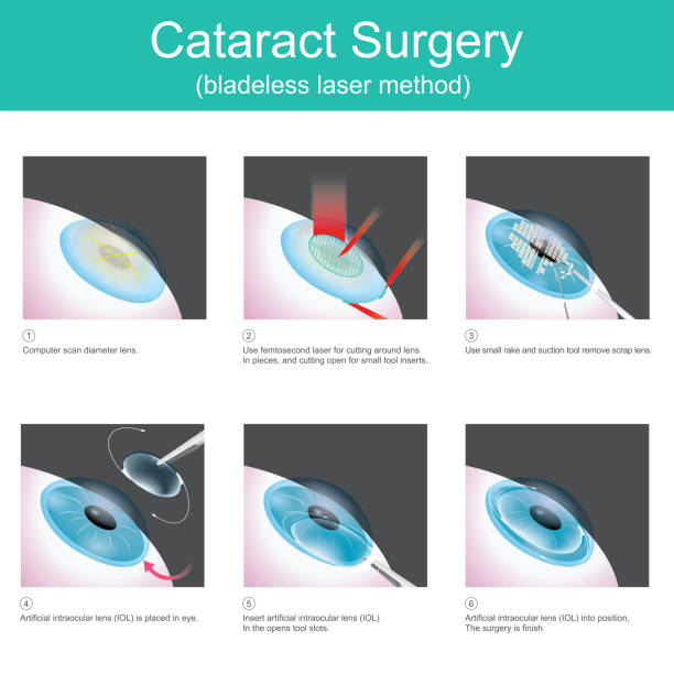 Cataract Surgery vector art illustration
