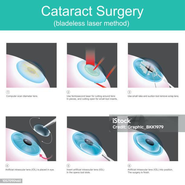 Cataract Surgery Stock Illustration - Download Image Now - Cataract, Surgery, Eye
