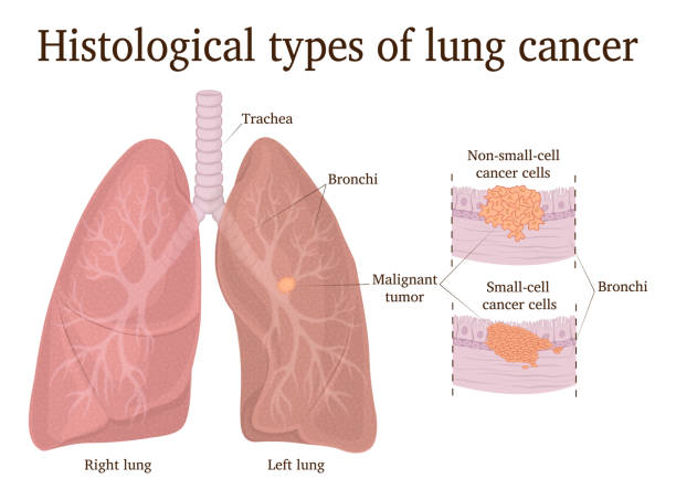 Illustration of lung cancer types Histological types of lung cancer - small cell and non-small cell small cell carcinoma stock illustrations