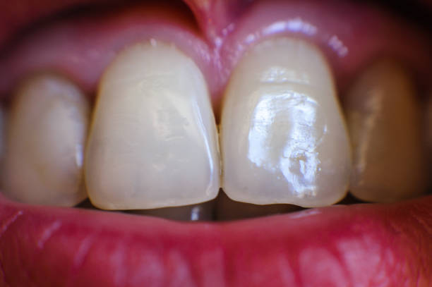 istock girl's teeth close up 1057171738