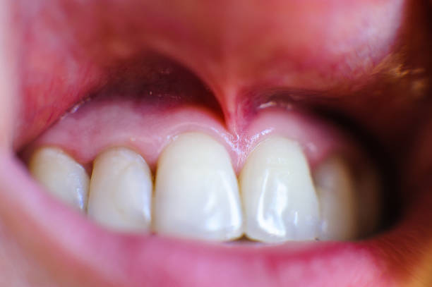 istock girl's teeth close up 1057171798