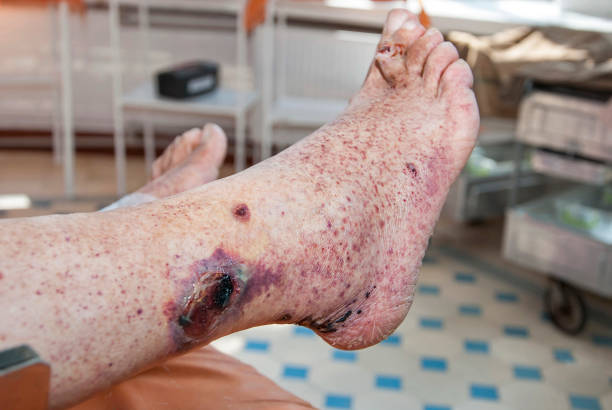 Hemorrhagic vasculitis. Diabetic foot syndrome Ulcer on the skin of the foot. Vasculitis stock pictures, royalty-free photos & images