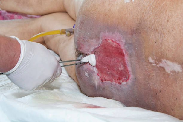 Decubitus sacrum in spinal injury Bedsore. Suppuration of wound. Decubitus sacrum in spinal injury. Surgical treatment. spinal surgery recovery stock pictures, royalty-free photos & images