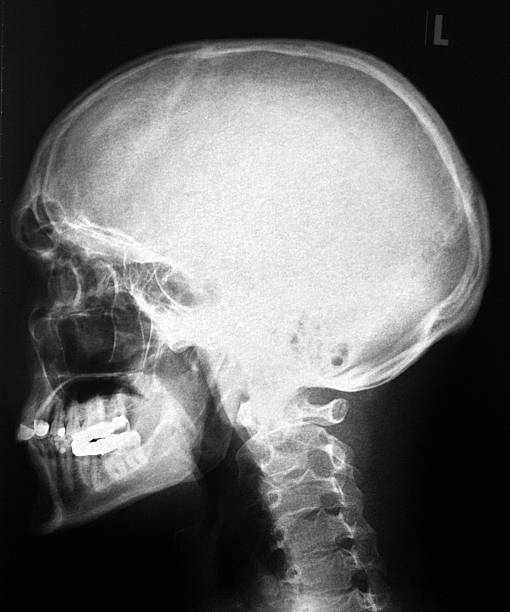 radiografie del cranio/head - vertebral body foto e immagini stock