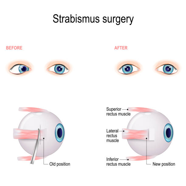 Strabismus Surgery Eye Muscle Recession Extraocular Muscle Anatomy Stock  Illustration - Download Image Now - iStock