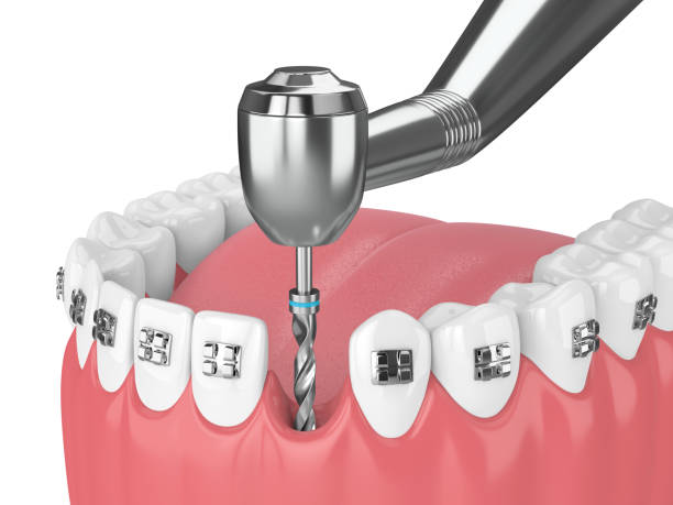 istock 3d render of teeth with orthodontic braces and dental drill 1057857112
