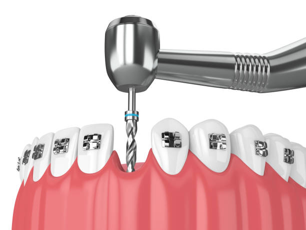 istock 3d render of teeth with orthodontic braces and dental drill 1057864506