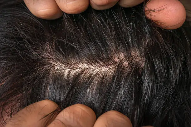 Closeup view of hair of a man with dandruff - psoriasis concept