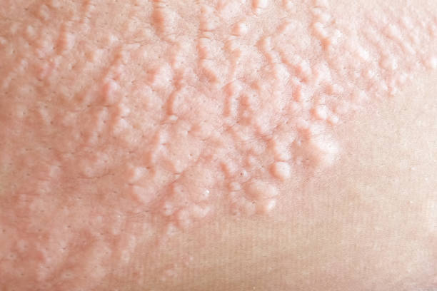 istock Macro Skin lesions 1058605960
