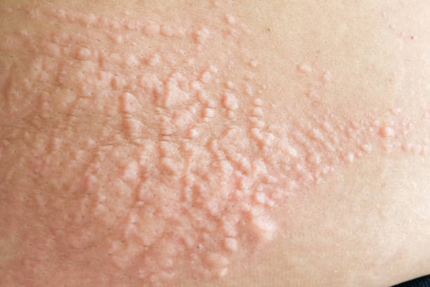 Macro Skin lesions stock photo