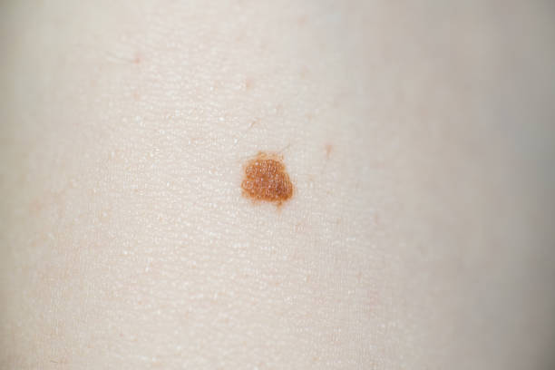 istock Close-Up Of Small Brown Mole With Tiny Hairs On Woman Hand 1058727348