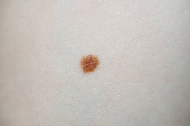 A close-up shot of a small brown mole on a woman's hand.