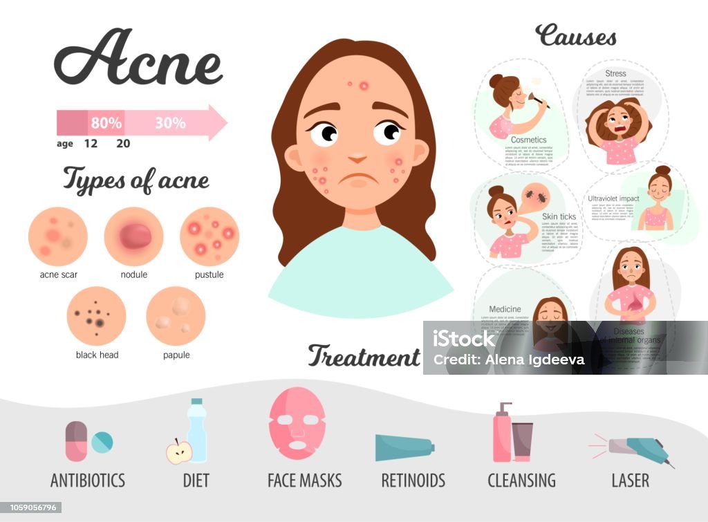 Infographics of acne. Infographics of acne. Causes of the disease, treatment. Types of acne. Acne stock vector