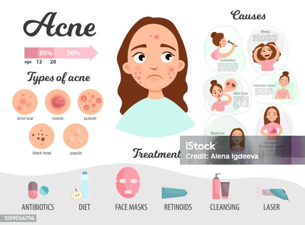 Infographics Of Acne Stock Illustration - Download Image Now - Acne, Adolescence, Facial Mask - Beauty Product