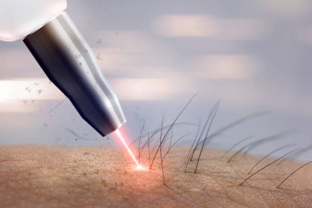 kosmetologie verfahren laser-haarentfernung auf körperteile. laserepilation. - laserlicht stock-fotos und bilder