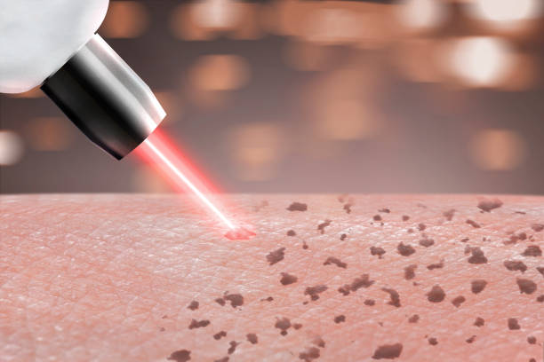procedura di cosmetologia rimozione laser della pelle lentigginosa sulle parti del corpo. da vicino - lentiggine foto e immagini stock