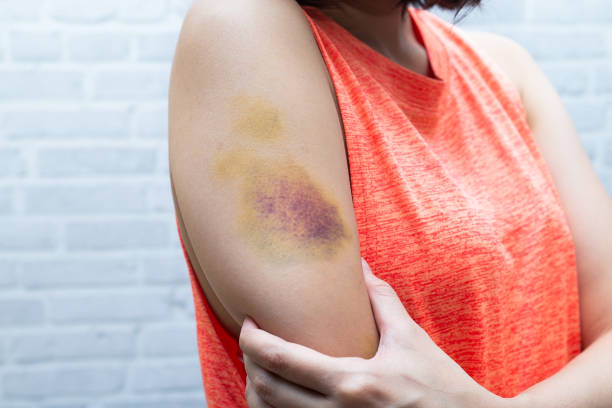 Bruise on woman arm. Injection bruises. Doctor and patient. stock photo