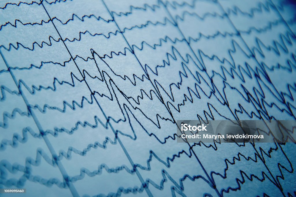EEG wave in human brain, brain wave patterns on electroencephalogram, problems in the electrical activity of the brain Medical research. EEG wave in human brain, brain wave patterns on electroencephalogram, problems in the electrical activity of the brain EEG Stock Photo