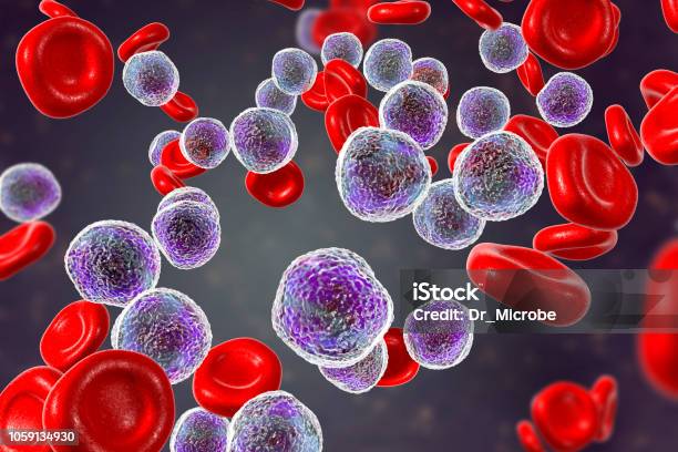 Acute Lymphoblastic Leukemia Stock Photo - Download Image Now - Bone Marrow Tissue, Leukemia, Blood