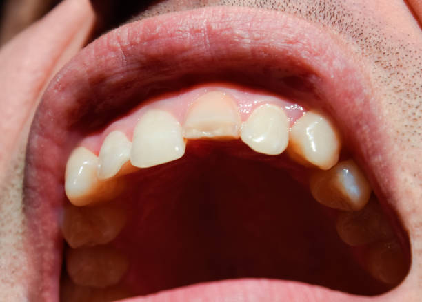 istock Broken tooth. Broken upper incisor in a man mouth. 1059139446