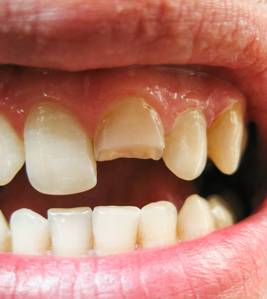 istock Broken tooth. Broken upper incisor in a man mouth. 1059140262