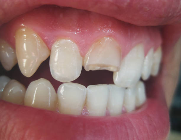 istock Broken tooth. Broken upper incisor in a man mouth. 1059140484