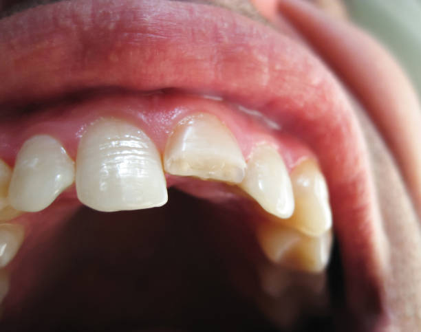 istock Broken tooth. Broken upper incisor in a man mouth. 1059140500