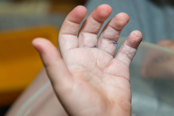 istock Stitches on child's finger 1059142280