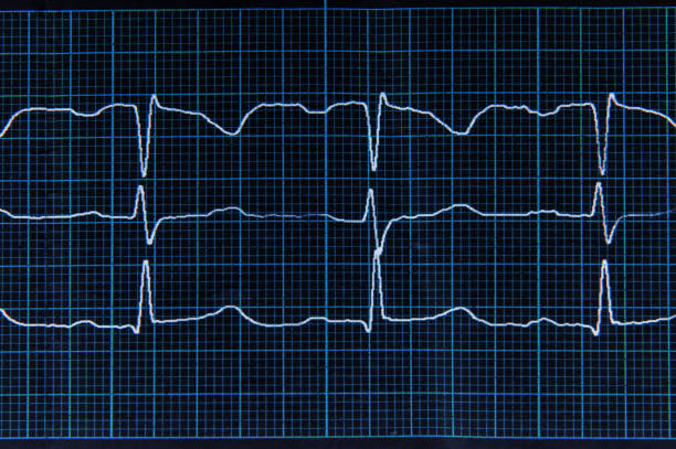 normale ekg mit arrhythmie-elementen. der herzschlag-linien auf dem bildschirm sind blau. - human heart surveillance computer monitor pulse trace stock-fotos und bilder