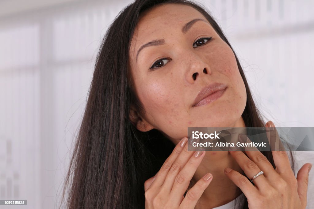 Skin Problems : Asian woman covering pimple scars and acne with powder foundation Acne Stock Photo