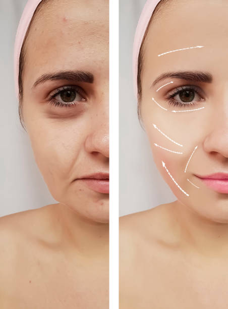 Girl's face eye wrinkles before and after procedure - before and after letybo treatment stock photos and pictures