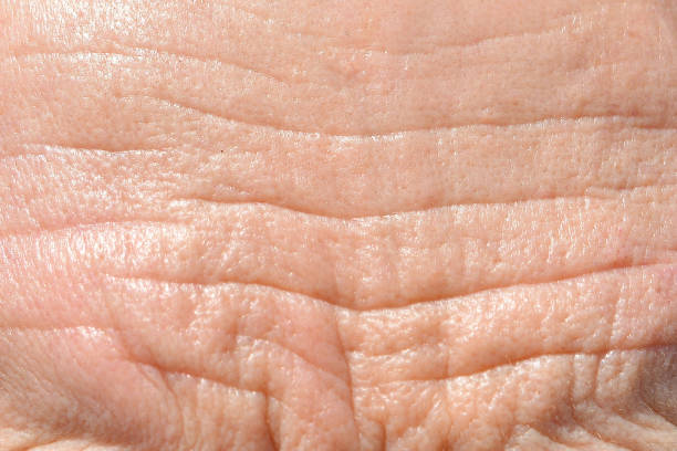 Men's forehead wrinkles in retirement