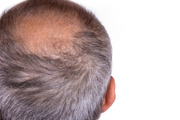Aged man concerned with hair loss. Baldness concept