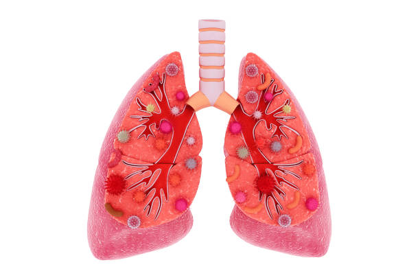 istock Virus and bacteria infected the Human lungs. lung disease 1059578486
