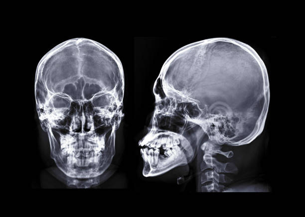 Human Skull X-ray images AP and Lateral View isolated on Black Background stock photo