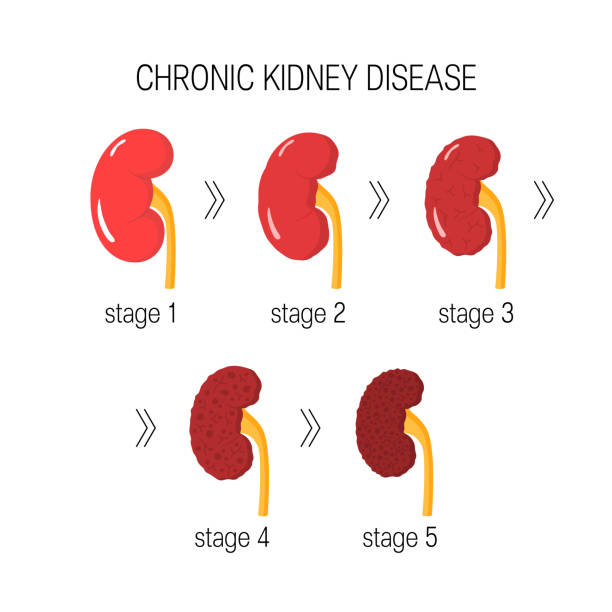 Chronic kidney disease vector Chronic kidney disease (CKD) concept. Vector illustration in flat style chronic kidney disease (CKD) infographic image stock illustrations