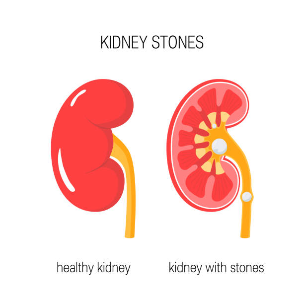 illustrazioni stock, clip art, cartoni animati e icone di tendenza di rene con vettore di pietre - kidney stone