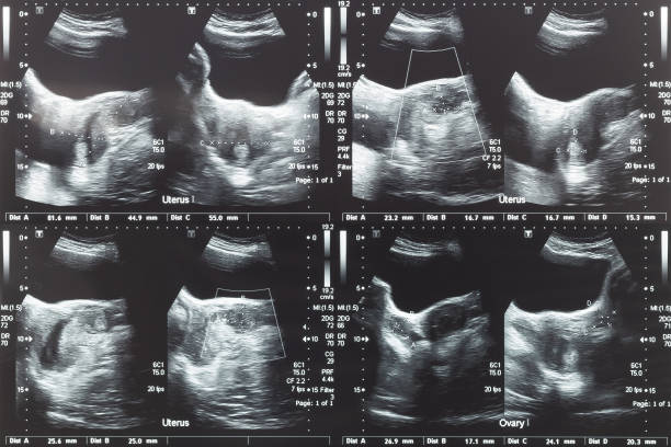 gambar ultrasound perut bagian bawah, ovarium dan rahim dengan tumor atau fibroid rahim, leiomyoma pasien wanita wanita untuk pemeriksaan medis ginekologi, analisis dan tes - ovarium foto potret stok, foto, & gambar bebas royalti