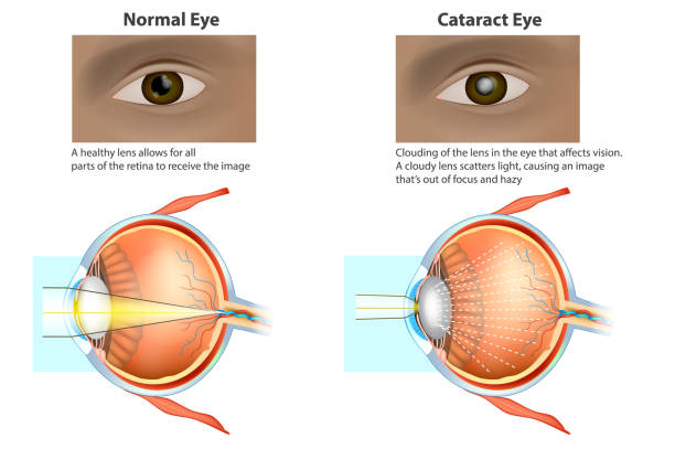 illustrazioni stock, clip art, cartoni animati e icone di tendenza di illustrazione medica di un occhio normale e di un occhio con una cataratta. - cataratta