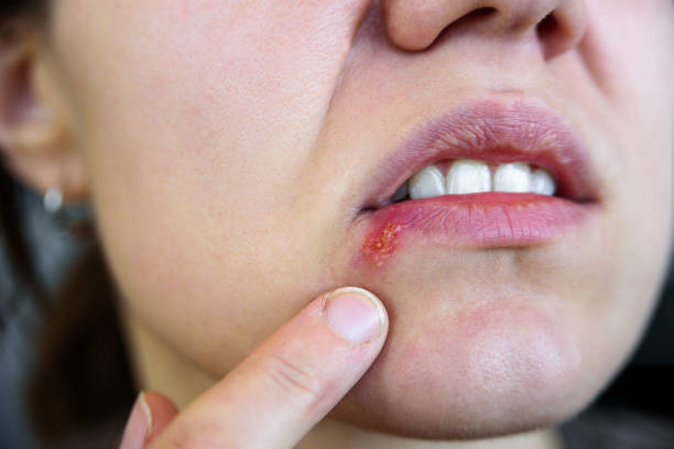 istock Young woman touching her lip herpes 1060474956