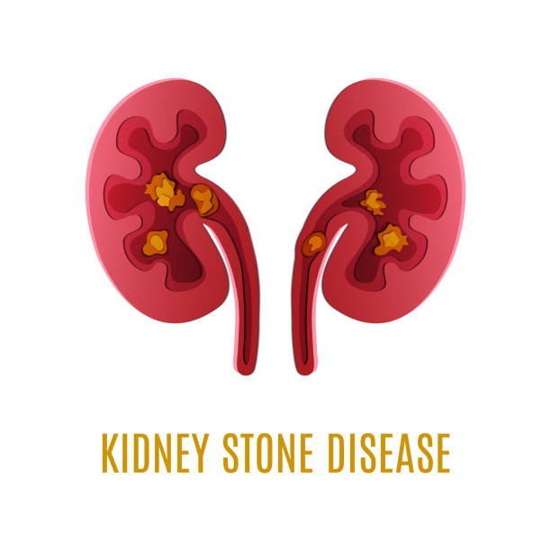illustrazioni stock, clip art, cartoni animati e icone di tendenza di poster 3d tagliato in carta per la malattia del calcolo renale - kidney stone
