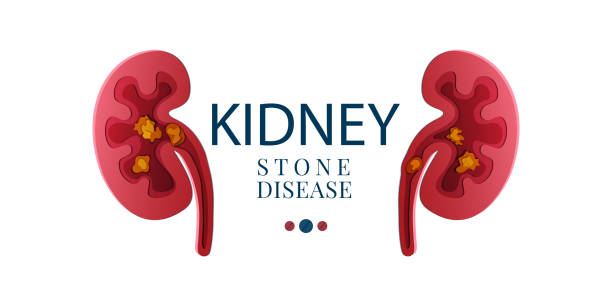 ilustrações, clipart, desenhos animados e ícones de cálculo renal doença papel cut poster 3d - kidney stone